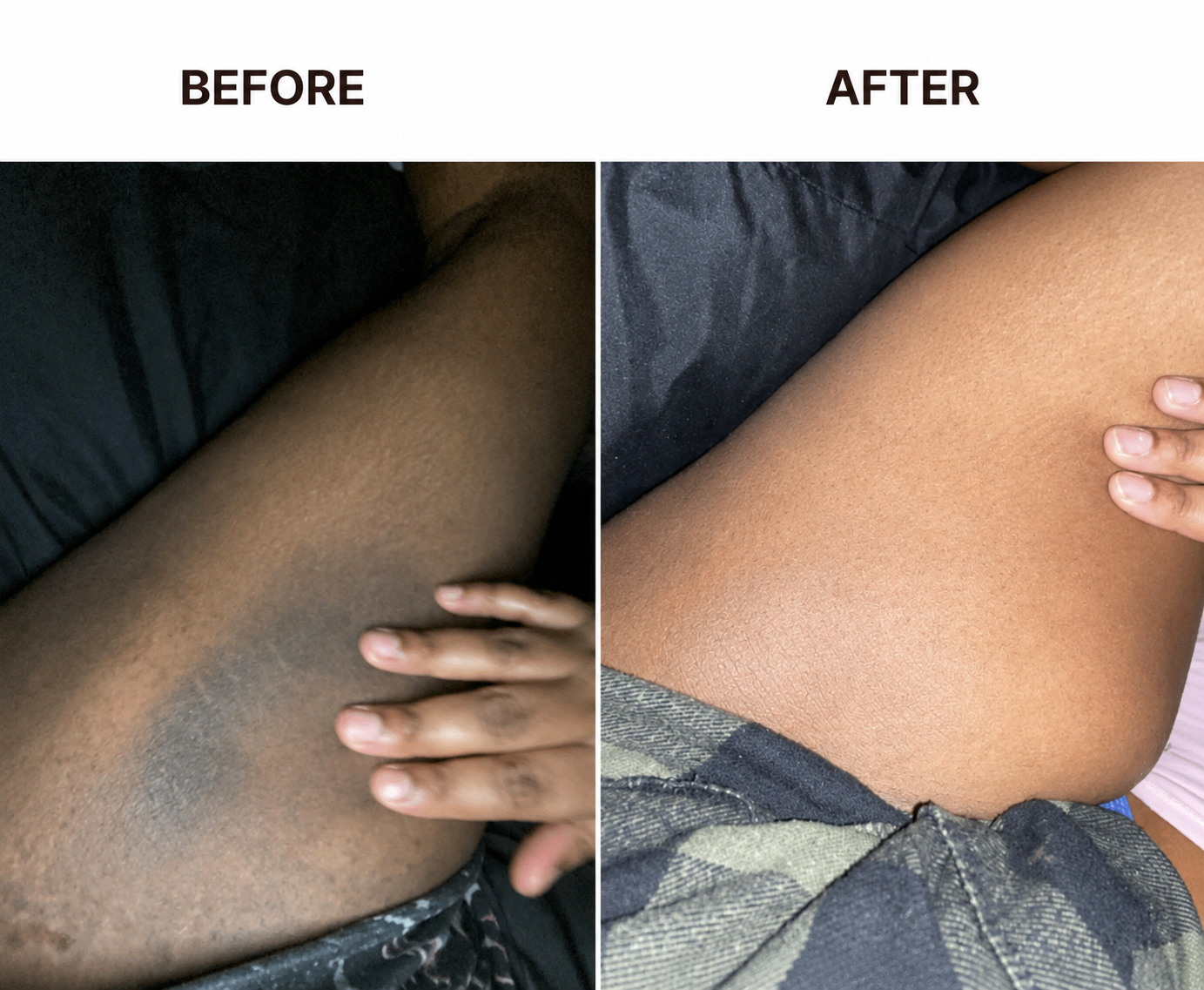 Before and after comparison showing changes in the appearance of inner-thigh pigmentation